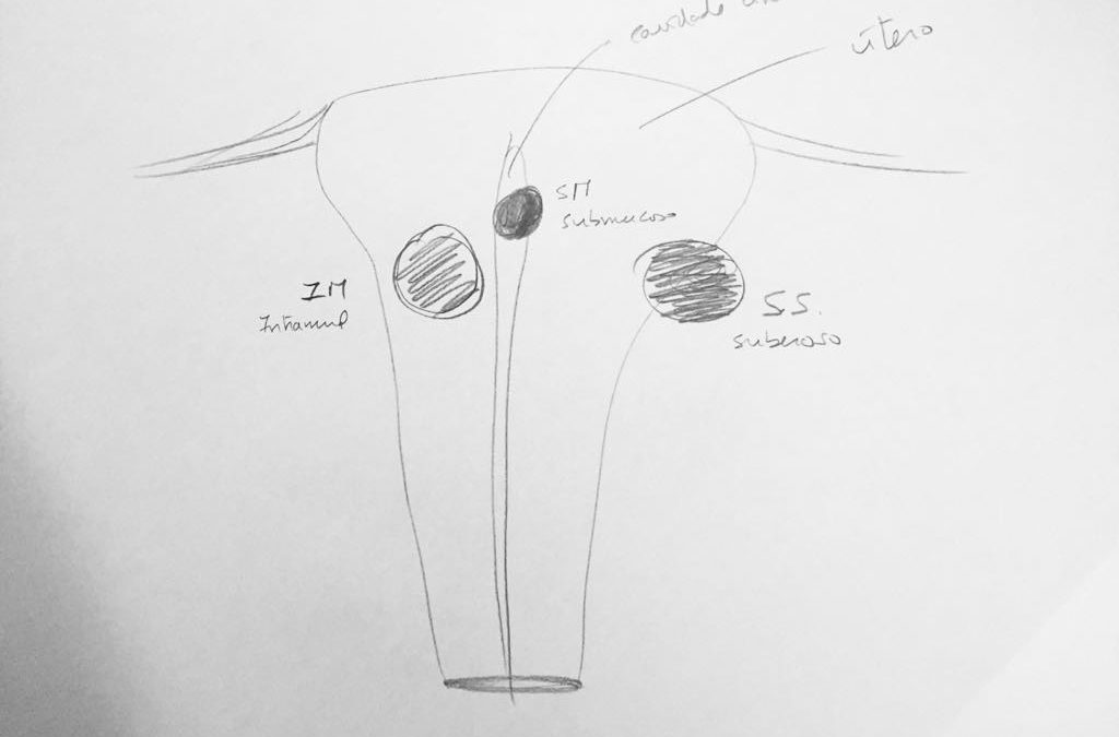 Miomas uterinos…